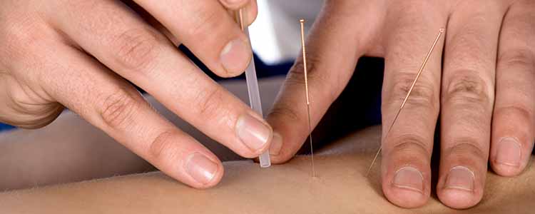 Dry Needling therapy Cork 